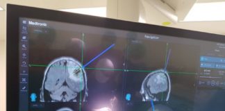 Niški neurohirurzi prvi put operisali tumore neuro-navigacijom Pacijentima je najpreciznijom metodom uklonjeno tumorno tkivo iz mozga, bez ikakvih neuroloških posledica
