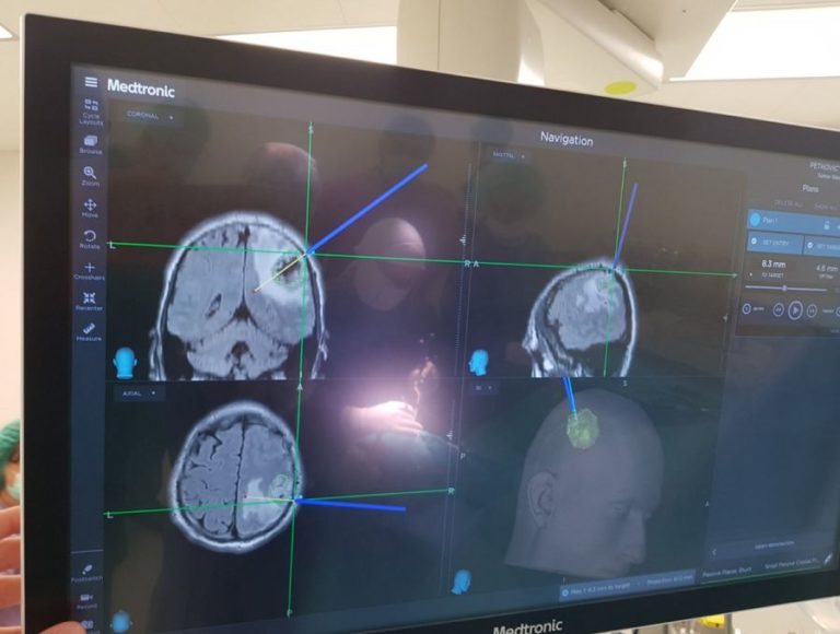 Niški neurohirurzi prvi put operisali tumore neuro-navigacijom
